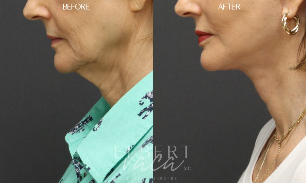 Case 1b Face Necklift